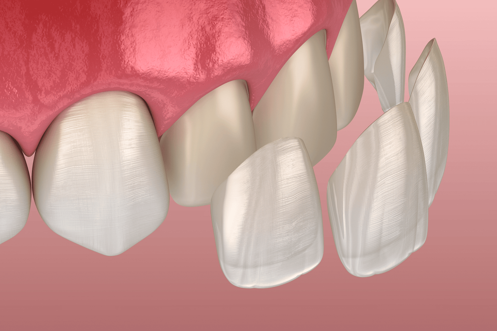 Strahlendes Lächeln mit perfekt geformten Veneers